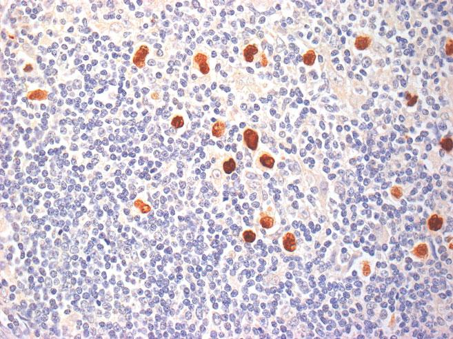 9 HIV-Associated Hodgkin Lymphoma 123 Fig. 9.3 In situ hybridization for EBV-encoded RNA (EBER) in H/RS cells of HIV-HL. The EBER signal is located to the nucleus.