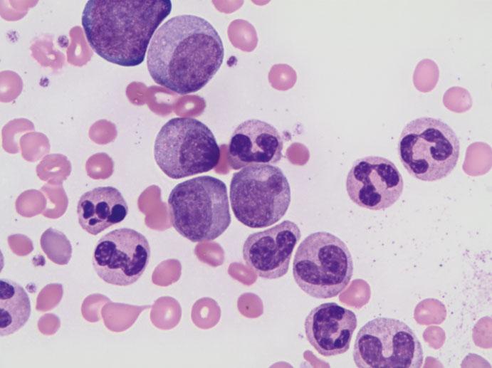 184 R.C. Fang and D.M. Aboulafia Fig. 15.2 Chronic myeloid leukemia (CML) (Image and description courtesy of Dr. Dick Hwang, Virginia Mason Medical Center) 15.