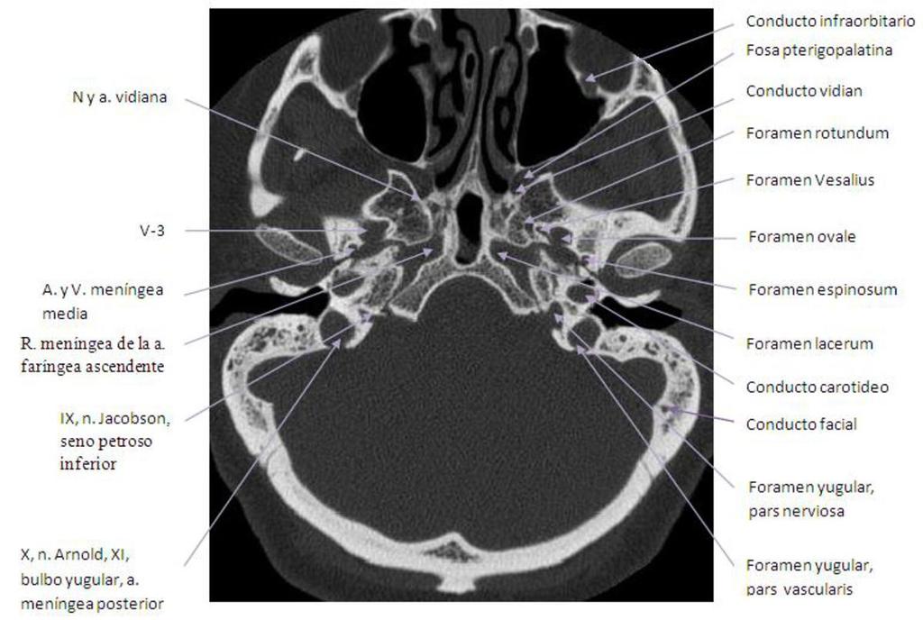 Harnsberger R, Hudgins R, Wiggins P, et al. Diagnostic Imaging: Head and Neck. Salt Lake City, Utah: Amirsys, Inc. 2004. Laine FJ, Nadel L, Braun IF. CT and MR imaging of the central skull base.