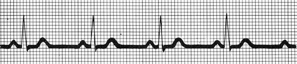 Cálculo de la frecuencia cardiaca (2) I.- Frecuencia de los comp