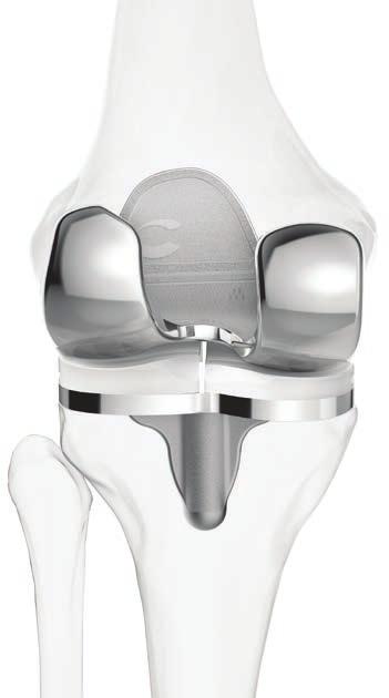 rodilla, que se utilizará para individualizar el implante.