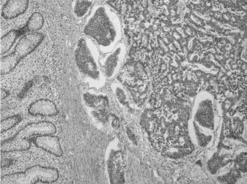 Tumores neuroendocrinos del aparato gastrointestinal y el páncreas A Figura 3. Carcinoma neuroendocrino de colon con invasión hacia la capa muscular propia.