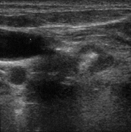 ) Debido l dificultos visulizción del nódulo por ví nterior -impedimento provocdo por un pobre ventn tiroide, clcificciones vsculres y cuello en flexión-, se relizó punción retrocrotíde con guj