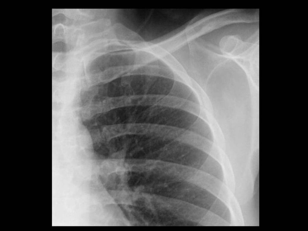 Fig. 2: Radiografía de tórax ampliada que
