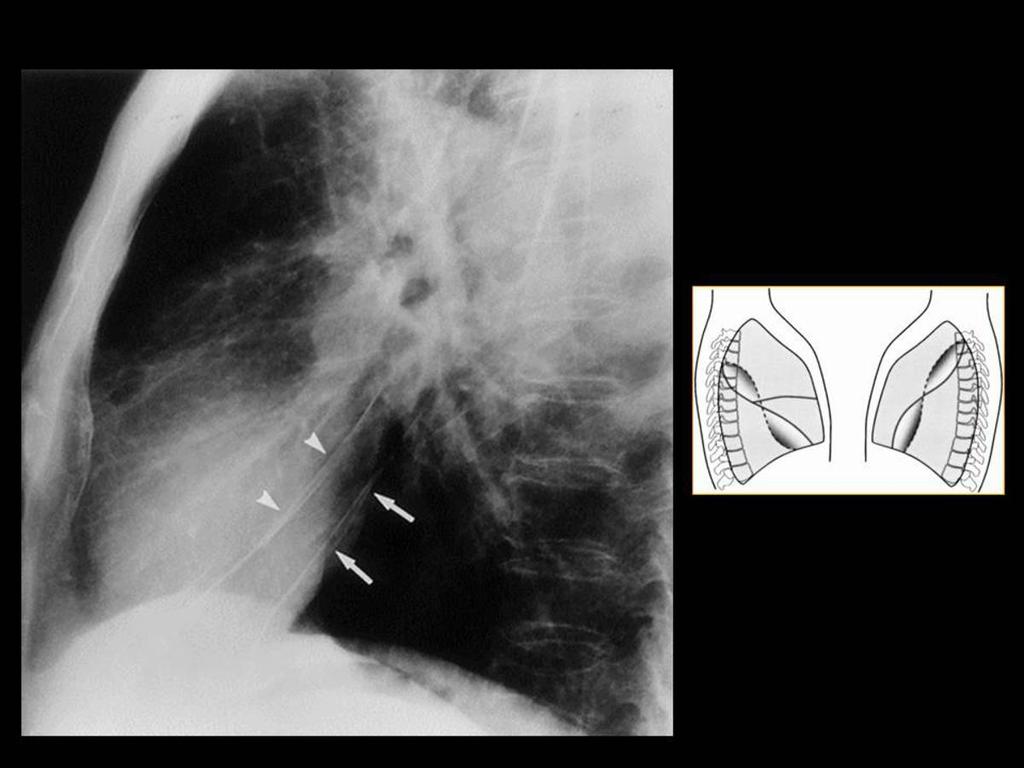 Fig. 4: Radiografía lateral de tórax y diagrama