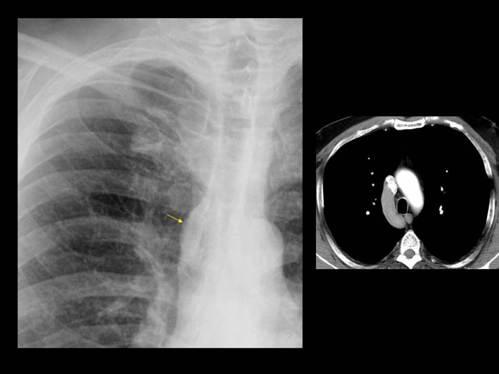 Fig. 14: Radiografía PA de tórax ampliada y TC de tórax axial con ventana de mediastino: