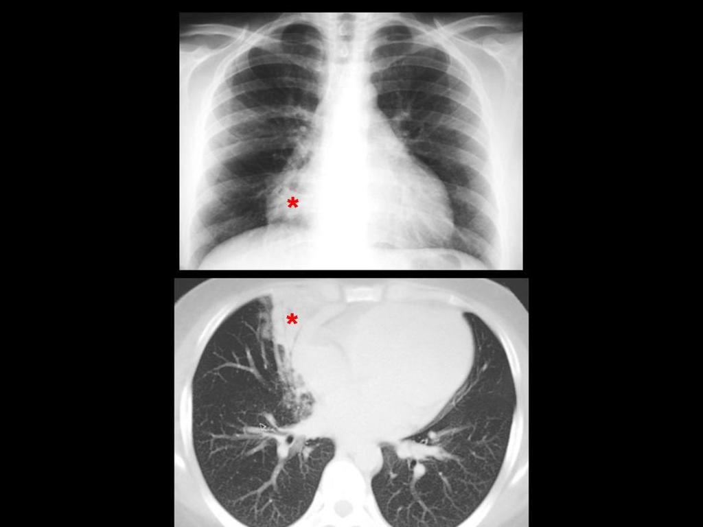 Fig. 15: Radiografía PA de tórax y TC axial de tórax con ventana de pulmón: