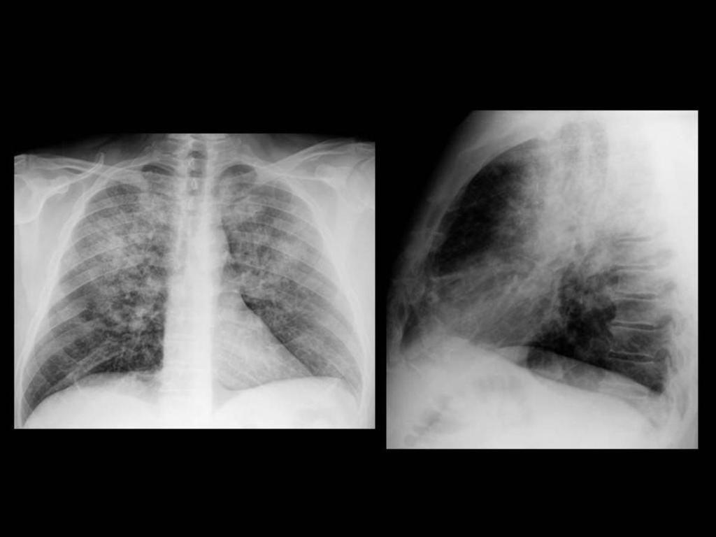 Fig. 29: Radiografía PA/LAT tórax: opacidades difusas en vidrio