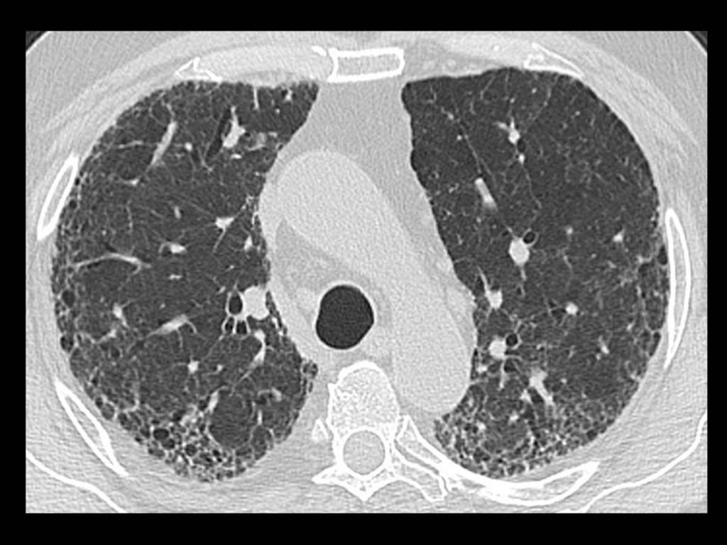 Fig. 32: TC de tórax axial con ventana de pulmón: patrón