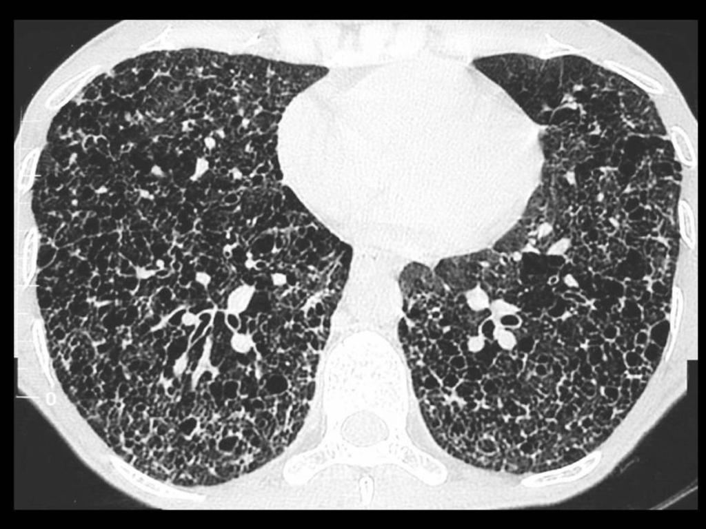Fig. 59: TC de tórax, axial, con ventana de pulmón: quistes pulmonares