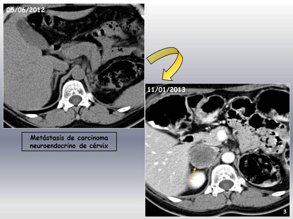Fig. 3: Mujer de 42 años con Ca. neuroendocrino de cérvix intervenido el 16/12/2009, con metástasis pulmonares y renal intervenidas. Masa suprarrenal derecha de 3.8 x 3.
