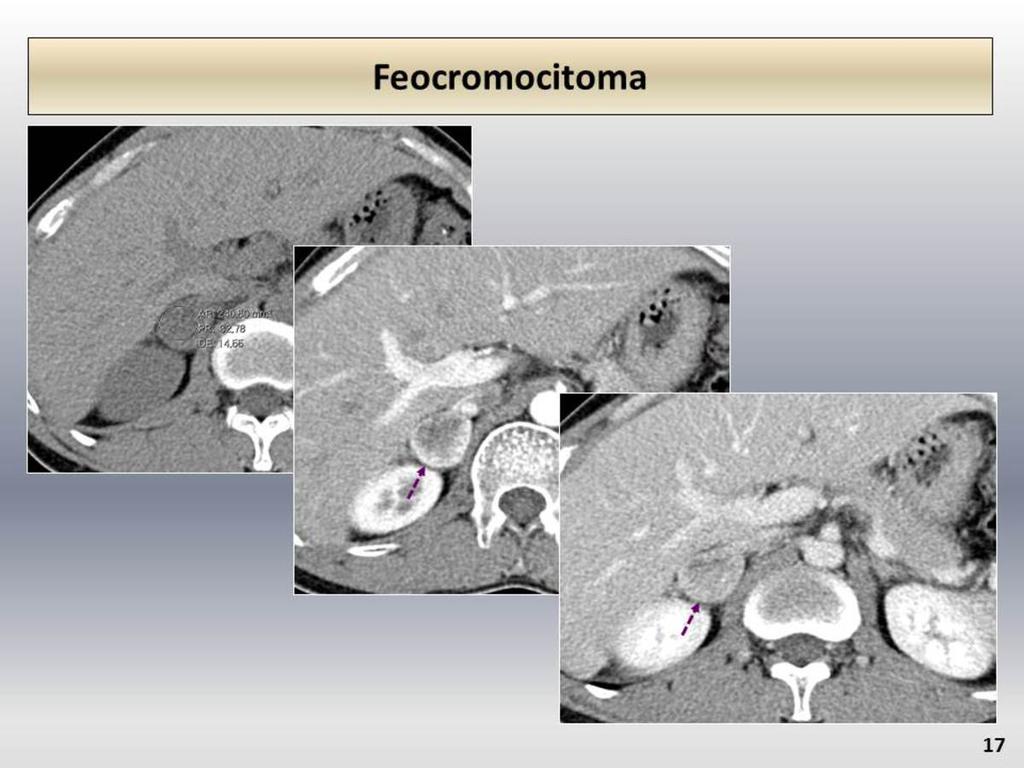 Fig. 17: Comportamiento hipervascular del feocromocitoma