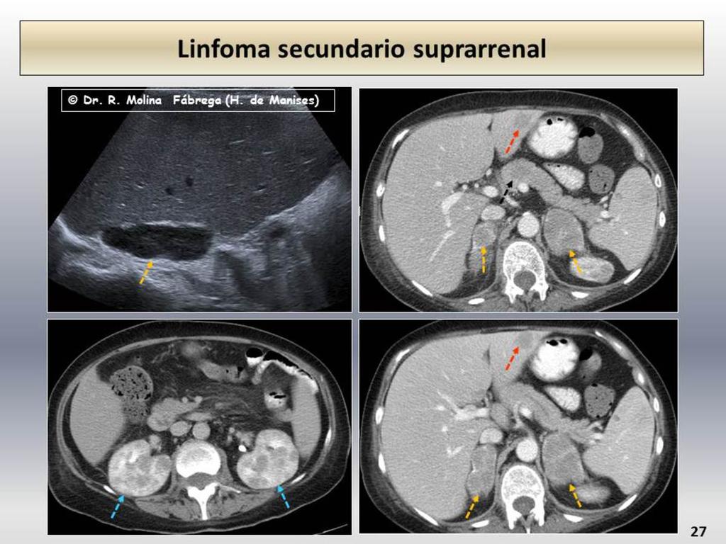 Fig. 27: Linfoma abdominal con afectación hepática (flecha roja), pancreática con dilatación del conducto pancreático principal (flecha negra), renal (flechas azules) y suprarrenal bilateral (flechas