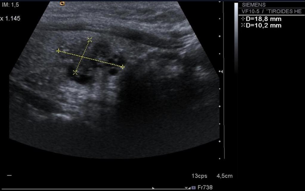 Fig. 12: Nódulo homogéneo, solido, hipoecogénico, de eje perependicular al plano cutáneo mayor que el paraleleo, que en la PAAF dio el diagnóstico de carcinoma papilar (Bethesda 6). Fig.