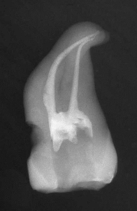 Radiografía post operatoria molar obturado con