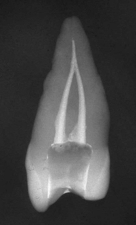 Radiografía post operatoria premolar obturado