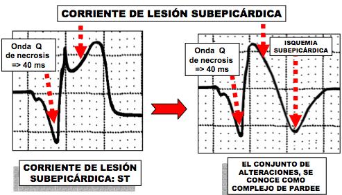 una elevación del punto J, con un segmento ST convexo, expresión de la corriente de lesion subepicárdica, y onda T negativa (Figura 3) Luego de los 20 minutos pueden apreciarse los cambios que se