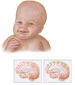 Hidrocefalia de los niños Definición Es una acumulación de líquido cefalorraquídeo en los ventrículos del cerebro que lleva a su aumento de tamaño e inflamación.