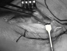 Se trata de una cápsula articular gruesa, que es preferible no resecar para poder suturarla más tarde.
