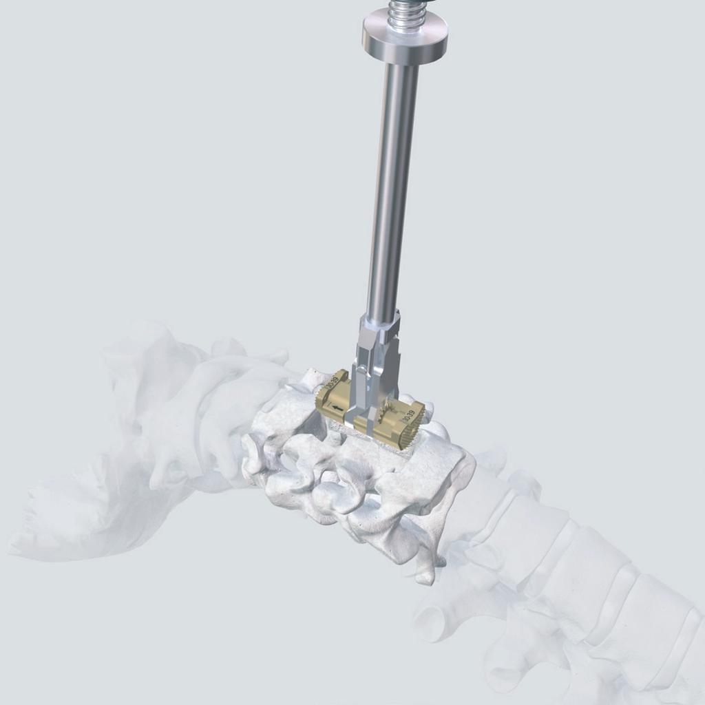5 Implantación Inserte el ECD en la parte separada de la columna vertebral y alinéelo en el plano sagital y frontal.