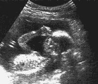 Las ondas de ultrasonido penetran en el abdomen de la madre y se reflejan en la superficie de feto.
