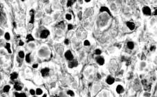 2002; Vol. 35, n.º 3 Nefritis lúpica Glomerulonefritis proliferativa difusa (Tipo IV) Fig. 5: Abundantes cuerpos hematoxinófilos, en un ganglio linfático.