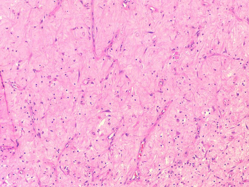 Fig. 41: ANATOMÍA PATOLÓGICA ANGIOFIBROMA NASAL: Células estromales (fibroblastos) de núcleos