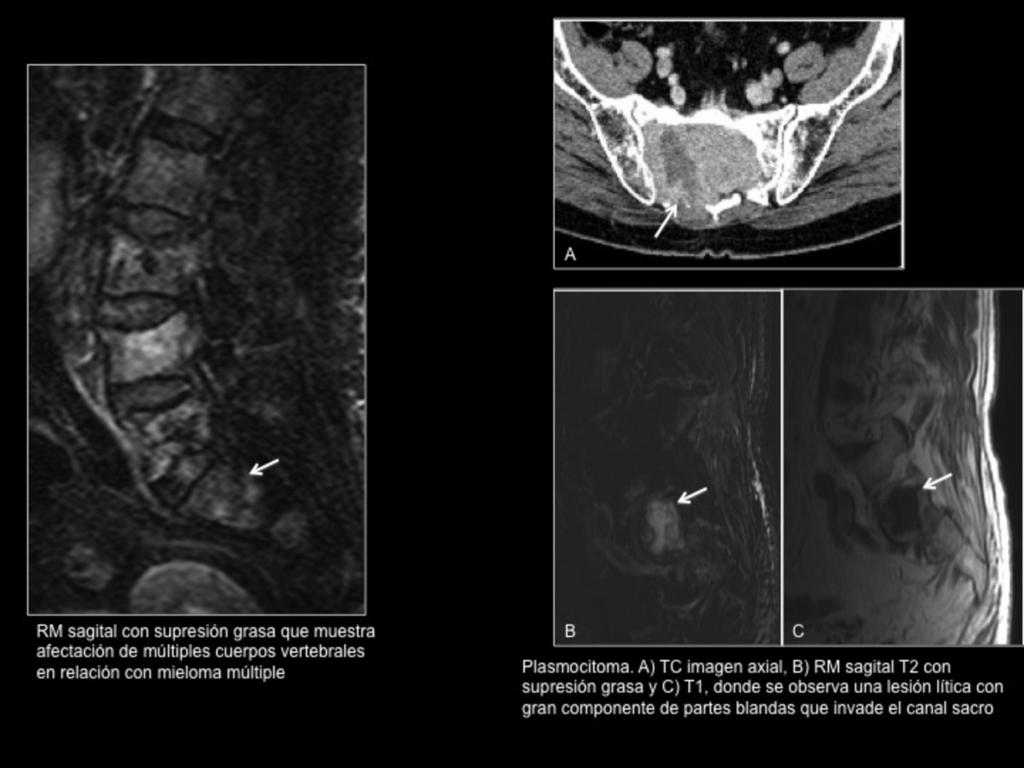 Fig. 14: Plasmocitoma/mieloma múltiple Cordoma (Figura 15) El cordoma es el tumor sacro primario maligno más frecuente.