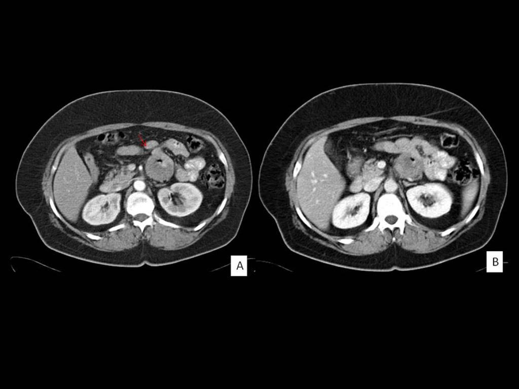 Fig. 4: TC con contraste intravenoso y oral, fase arterial(a) y portal(b).