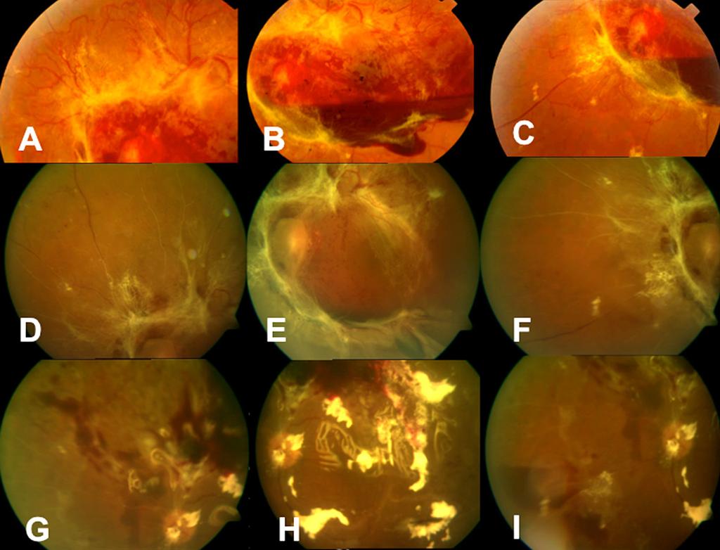 Wu L et al. Bevacizumab Intravítreo (Avastin ) en Retinopatía Diabética el bevacizumab intravítreo puede aminorar la necesidad de vitrectomía en ojos con hemorragia vítrea secundaria a RDP.
