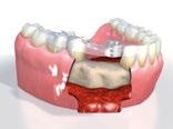 Las guías quirúrgicas pueden fijarse sobre la mucosa, los dientes o