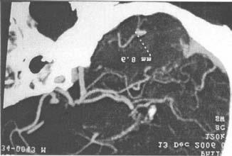 8 mm por tal motivo se solicita una angiografía cerebral (figura 2, 3 y 4).