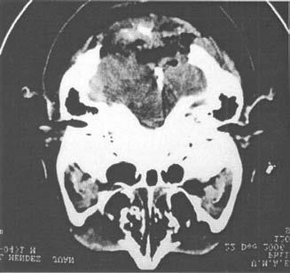 neumoencéfalo, resangrado o hidrocefalia (figura 8 y 9), es extubado el mismo día de su ingreso a UCI sin complicaciones y egresado a piso, en el cual