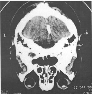 Angiografia cerebral de circulación posterior vista AP (figura 5), lateral (figura 6) y oblicua (figura 7) con una lesión aneurismática bilobulado de la