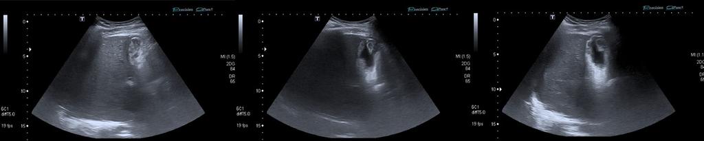 hidroaéreo. TC abdomen con contraste iv: gas en pared vesicular e intraluminal. Fig.