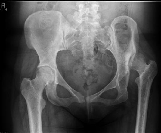 cambios radiológicos, es lo que dictará la necesidad de la artroplastia.