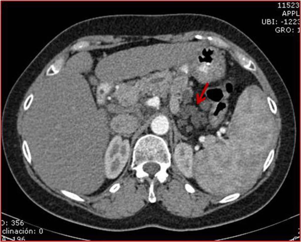 Fig. 3: Mismo paciente de la figura 2: TC multicorte con contraste iv, reconstrución coronal. Se aprecia contenido hiperdenso en zona inferior del pseudoquiste en relación con hemorragía (flecha).