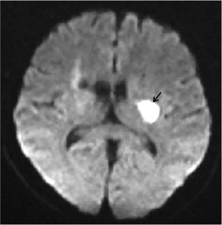 Anatomía y fisiopatología de la enfermedad cerebrovascular a través de imágenes 15 Inmediatos - Ausencia de vacío de flujo normal - Realce por contraste intravascular - Bajo coeficiente de difusión