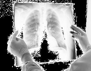 El cáncer de pulmón es el segundo más frecuente en hombres y el cuarto en mujeres en