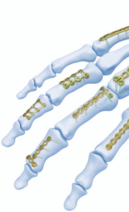 artrodesis de las articulaciones interfalángicas 4 Fracturas de los metacarpianos, los huesos del carpo y la porción distal del radio (técnica