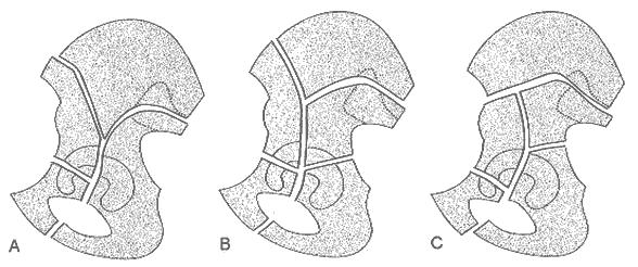 (Fig.9) Fig.9. Fractura C3 Estas fracturas dividen ambas columnas por encima del acetábulo, a través del Ilium en el plano coronal con extensión en forma de T hacia la articulación.