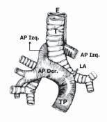 La arteria pulmonar izquierda aberrante cruza sobre el bronquio fuente derecho y luego pasa desde la derecha a izquierda, posterior a la tráquea o carina y anterior al esófago, después sigue