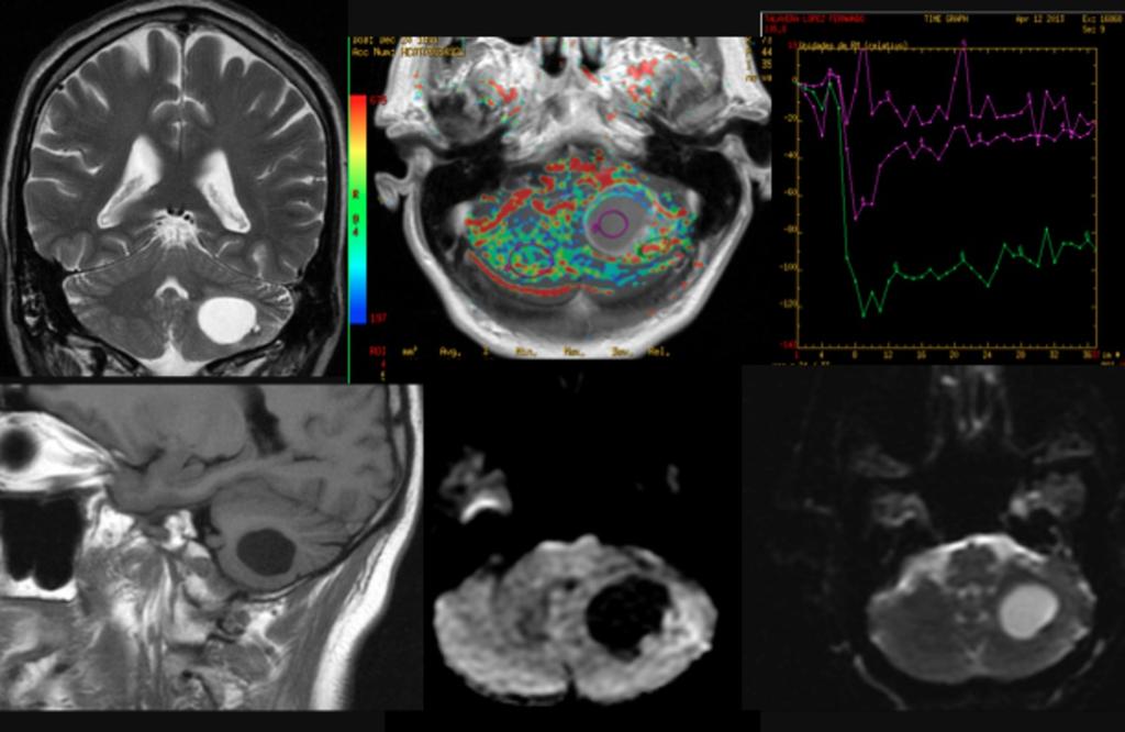 Fig. 23: Paciente con lesión expansiva de aspecto quístico y pequeño nódulo de aspecto sólido en hemisferio cerebeloso izquierdo, con escaso edema vasogénico asociado, que deforma el IV ventrículo y