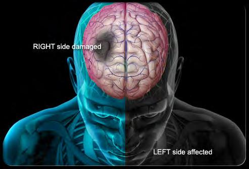 Efectos en el control del movimiento La corteza motora se deteriora, la médula esp se preserva Alto grado de discapacid (control