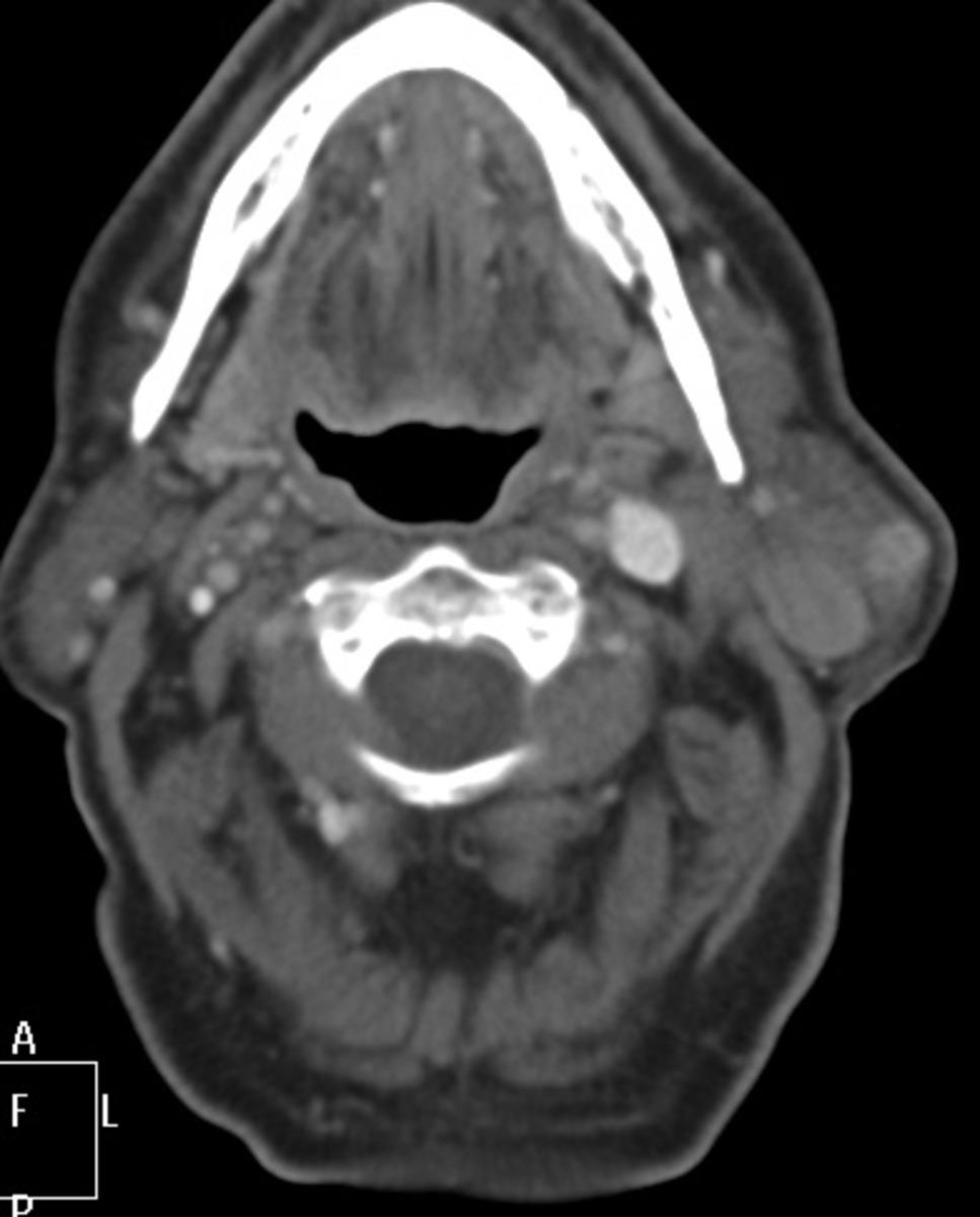 Fig. 23: TC axial post administración de civ que muestra lesión nodular intraparotídea izquierda, con captación de contraste y otra lesión nodular