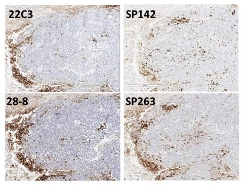 Limitaciones de la determinación de la expresión de PD-L1: Análisis de células tumorales/células inmunes Células tumorales Análisis expresión PD-L1 Células inmunes No se estudia por separado la