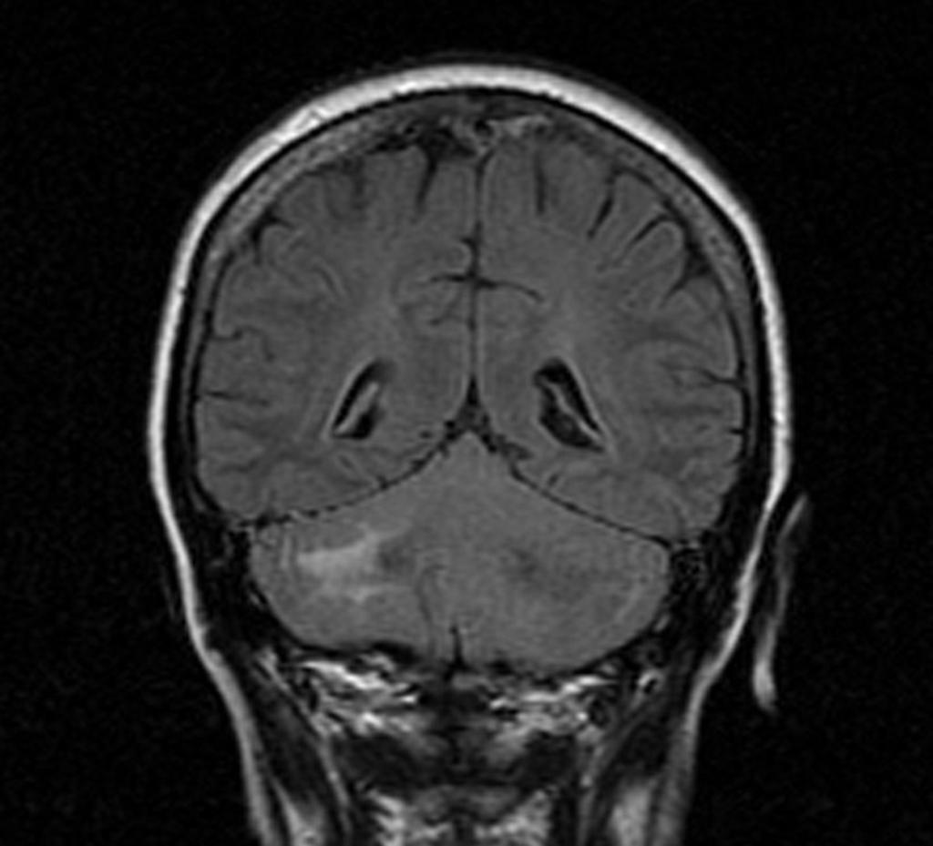 Fig. 7: Imagen de RM coronal FLAIR: Cambios de señal en sustancia blanca del hemisferio cerebeloso derecho