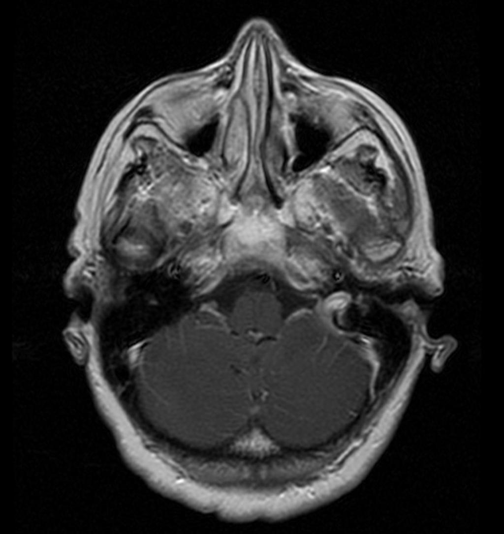 Fig. 8: Imagen de RM axial potenciada en T1 con gadolinio: No muestra realce patológico tras administración