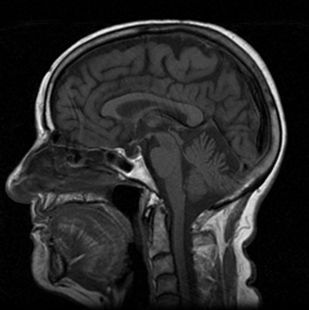Fig. 9: Imagen sagital de RM potenciada en T1: Se identifica moderada atrofia cerebelosa.