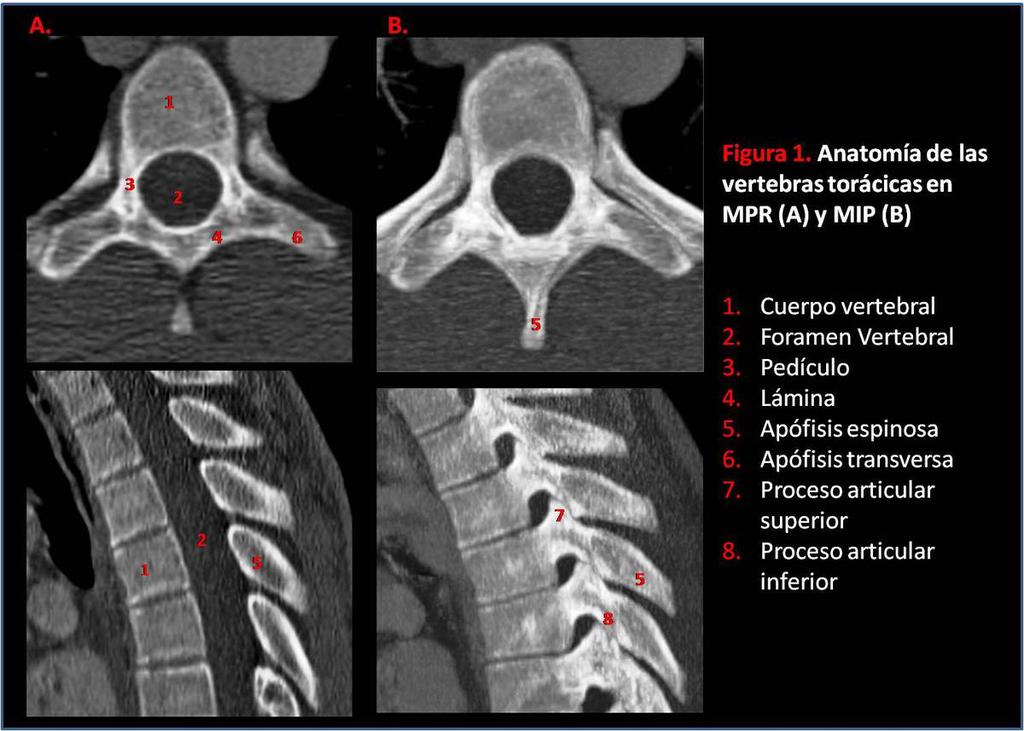 Fig. 1: Anatomía de las vertebras